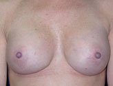 Patient # 10776 After Photo # 2
